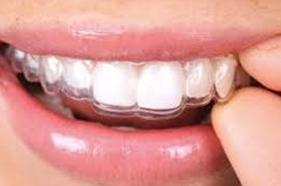 Clear Aligners